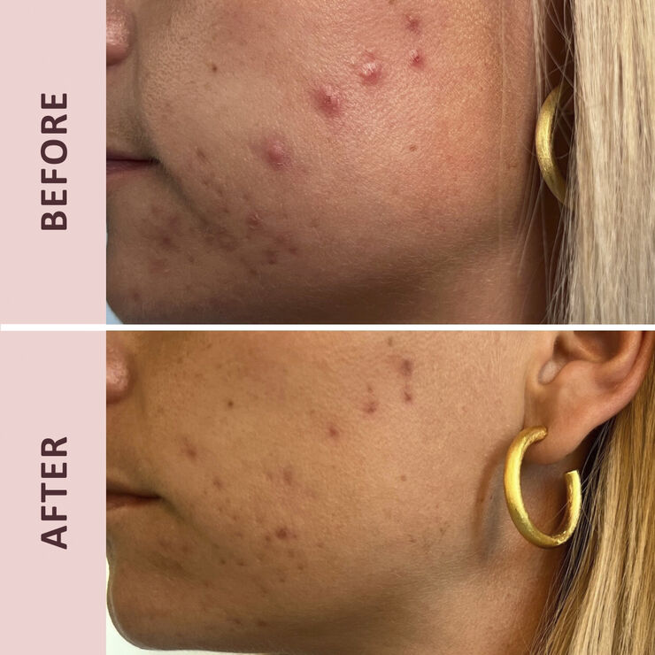 Pudderdåserne Azelainsyre 10%