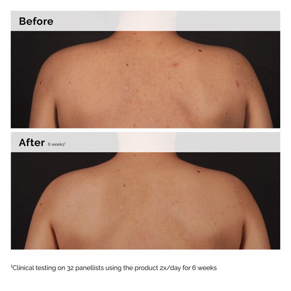 Salicylic Acid 0. 5% Body serum