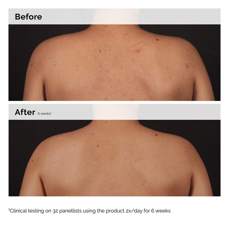 Salicylic Acid 0. 5% Body serum