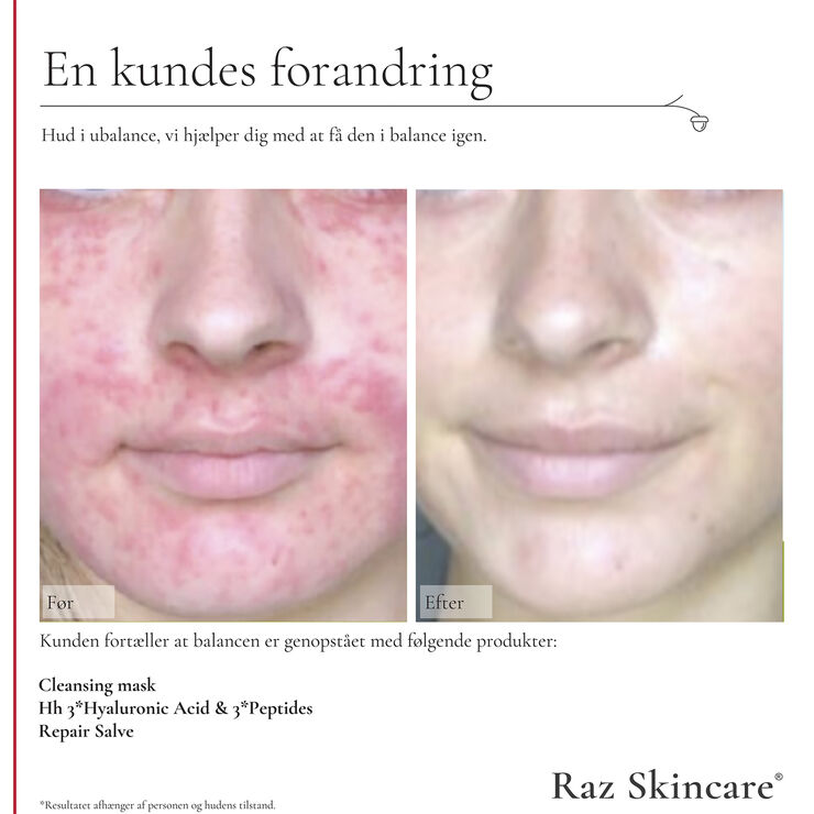 Raz Skincare Hh 3*Hyaluronic Acid & 3*Peptides 30 ml