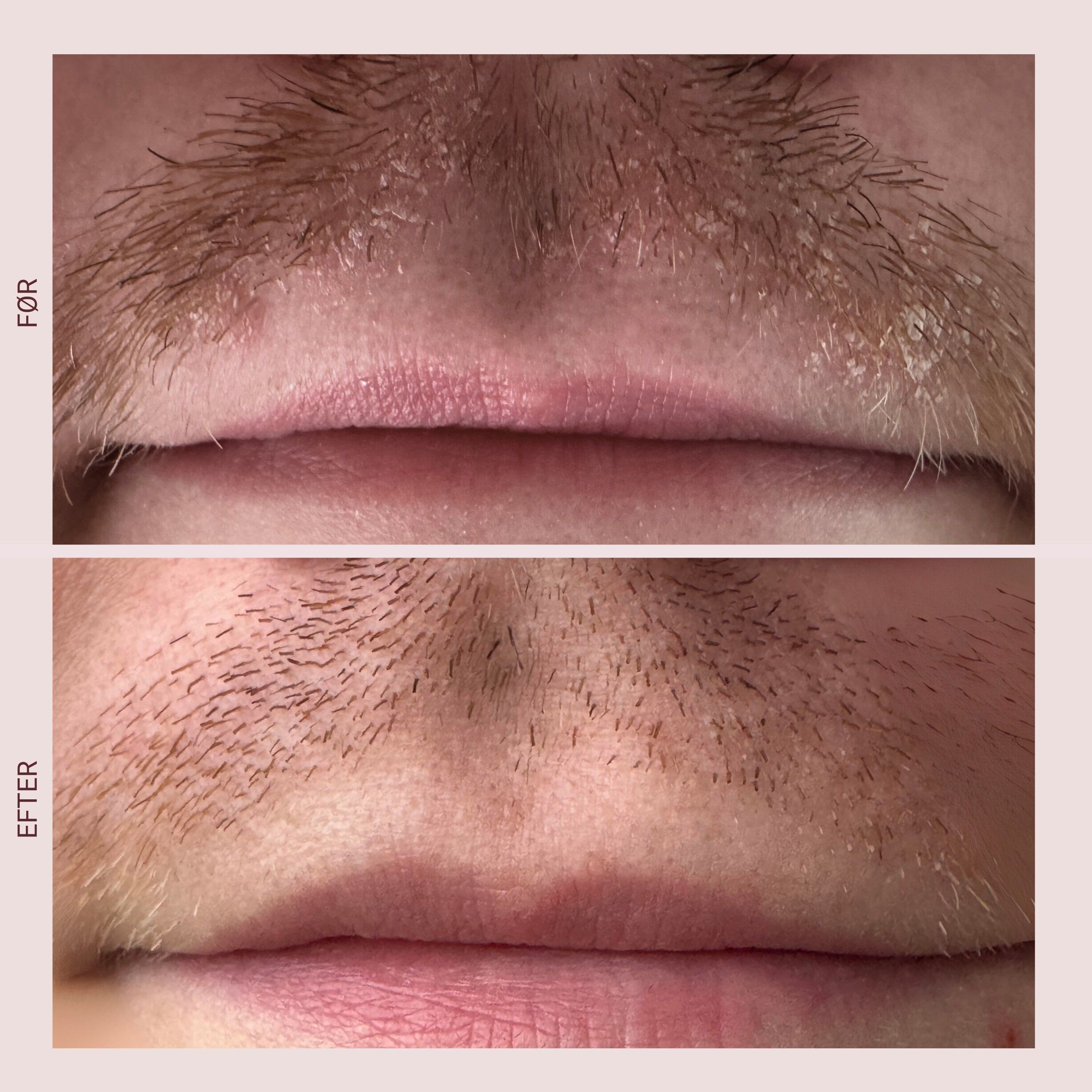 Pudderd&aring;serne Sk&aelig;l serum