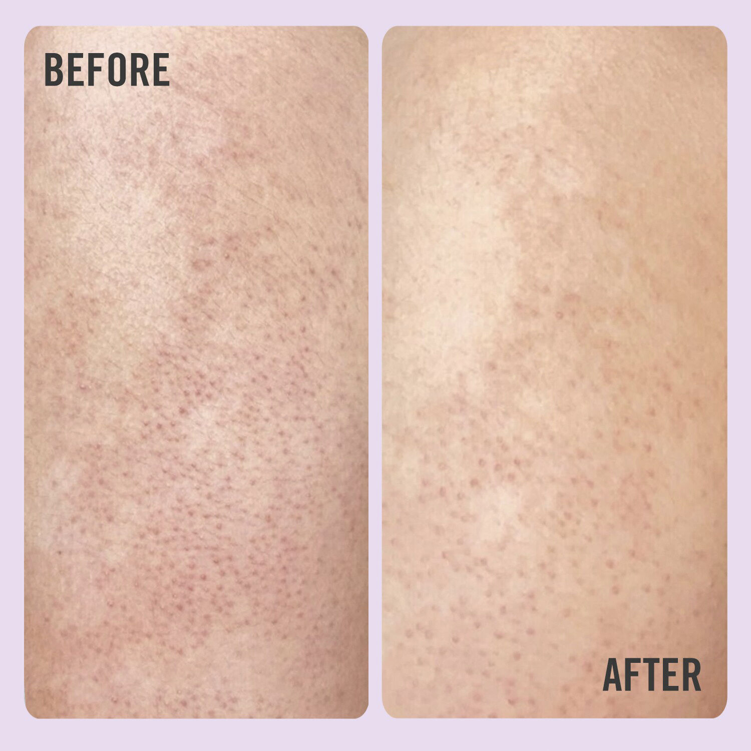 DAILY ESSENTIALS KP BODY SCRUB 10%