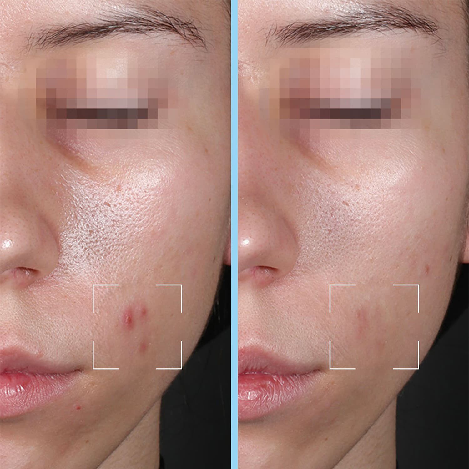 Purity Capsules - Serum mot orenheter, berikat med salicylsyra och HA