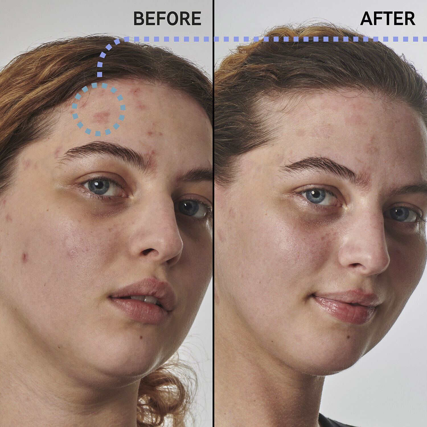 Dry and rough skin slution with 10% urea - Face serum