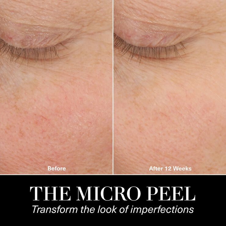 The Micro Peel Facial Peeling