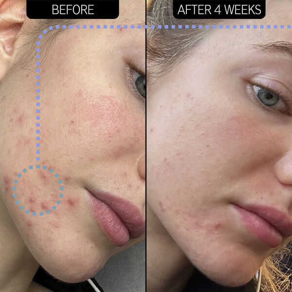 SUPER SOLUTIONS 2% NOVORETIN MOIST