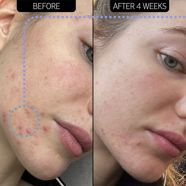 SUPER SOLUTIONS 2% NOVORETIN MOIST