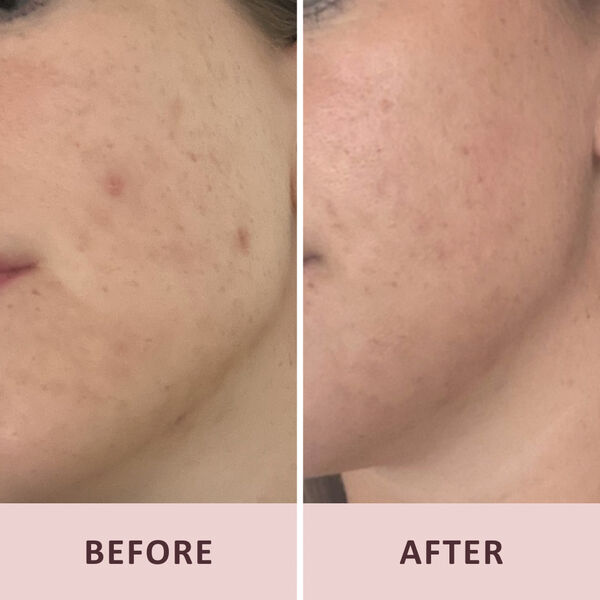 Pudderdåserne Azelainsyre 10%