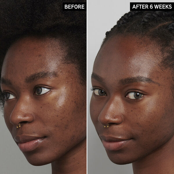 Nattbehandling med tranexamsyra mot hyperpigmentering