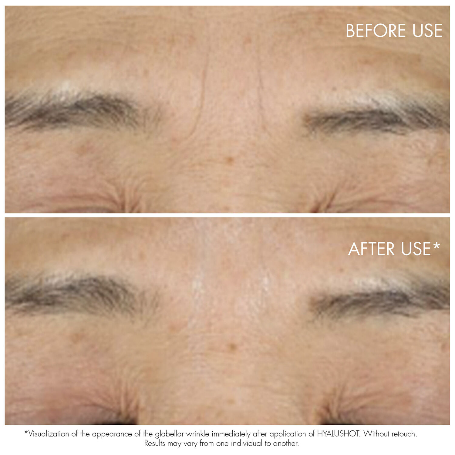 Capture Totale Hyalushot Concentre Tube