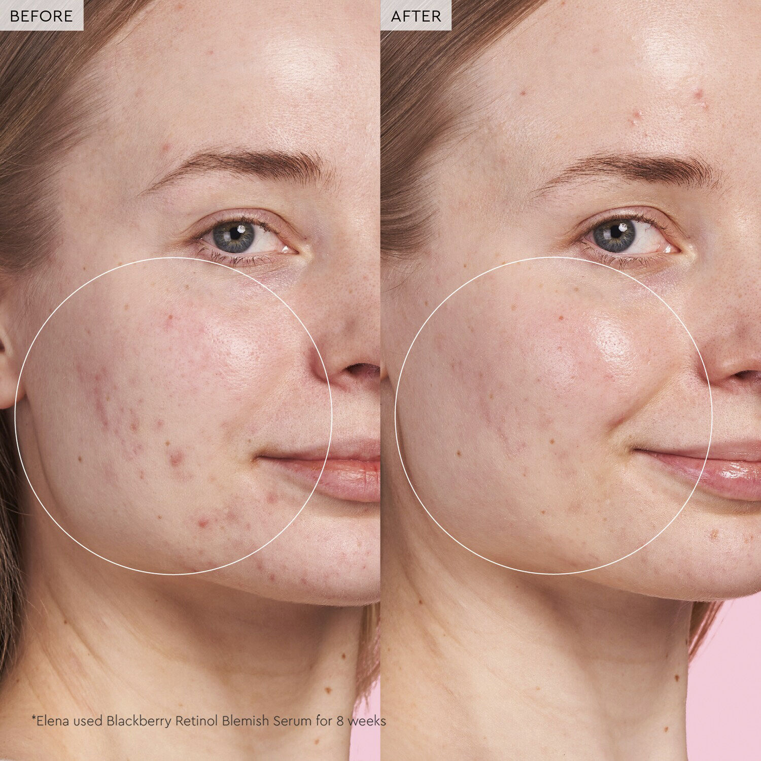 Blackberry Retinol - Serum mot blemmor