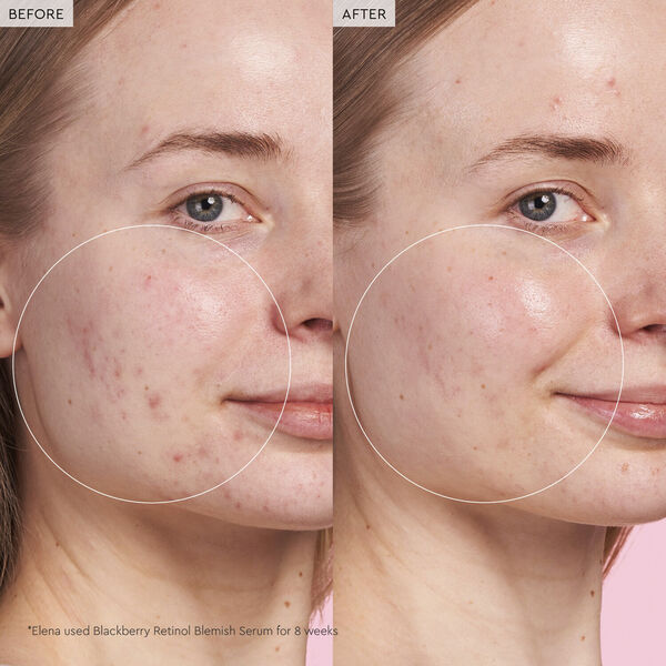 Blackberry Retinol - Serum mot blemmor