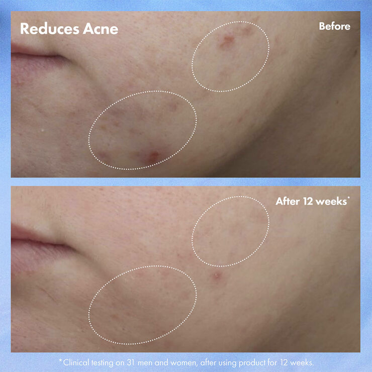 Clear Improvement Acne & Blackhead Clearing Hydrating Moisturizer Loti