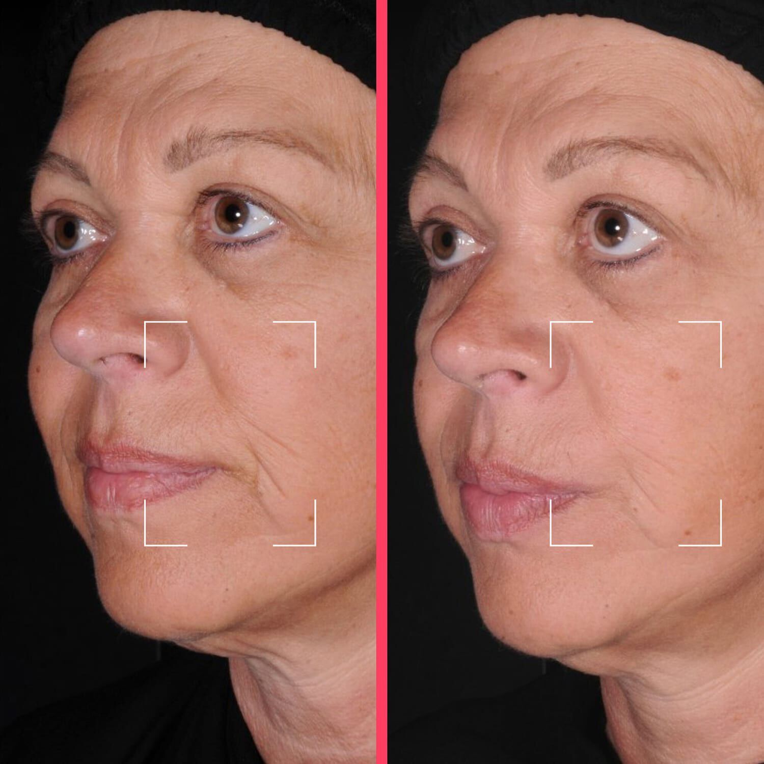 Lift Capsules - Lyftande serum berikat med niacinamid, peptider och HA