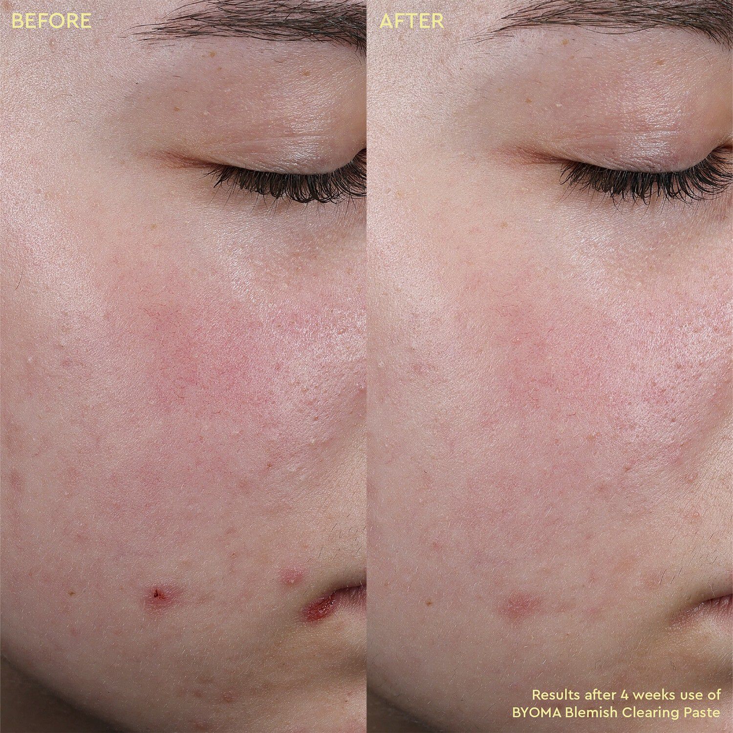 Blemish Clearing Paste - Salva mot oj&auml;mnheter