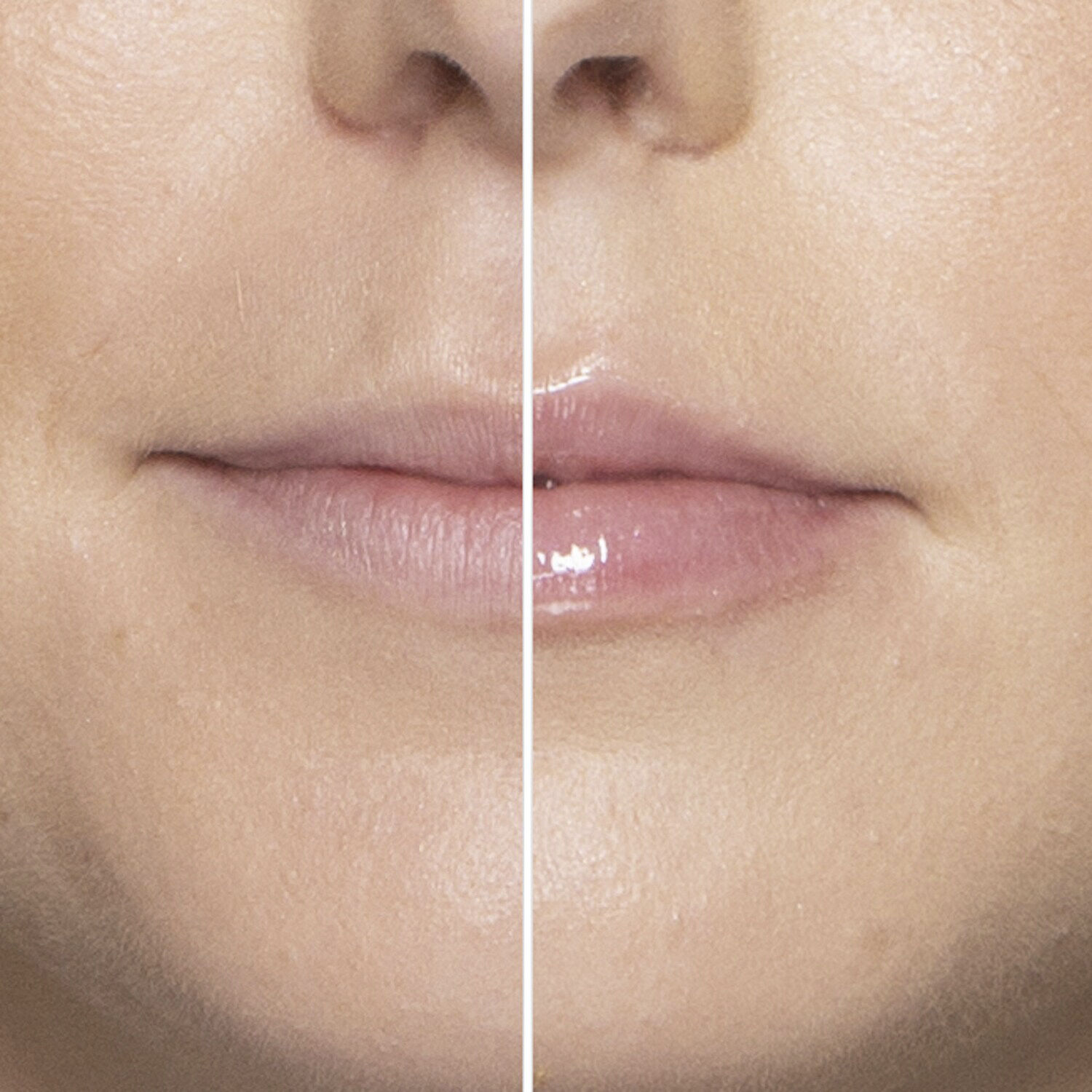 Lip Injection - Extreme Mini