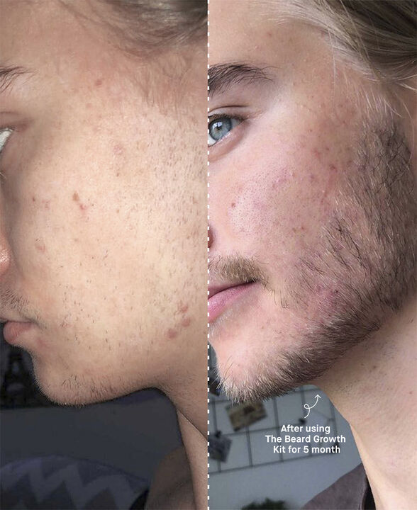 The Beard Growth Kit