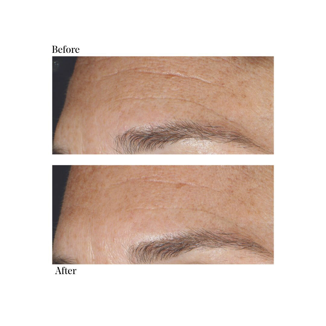 Replenishing Multi-Acid Peel