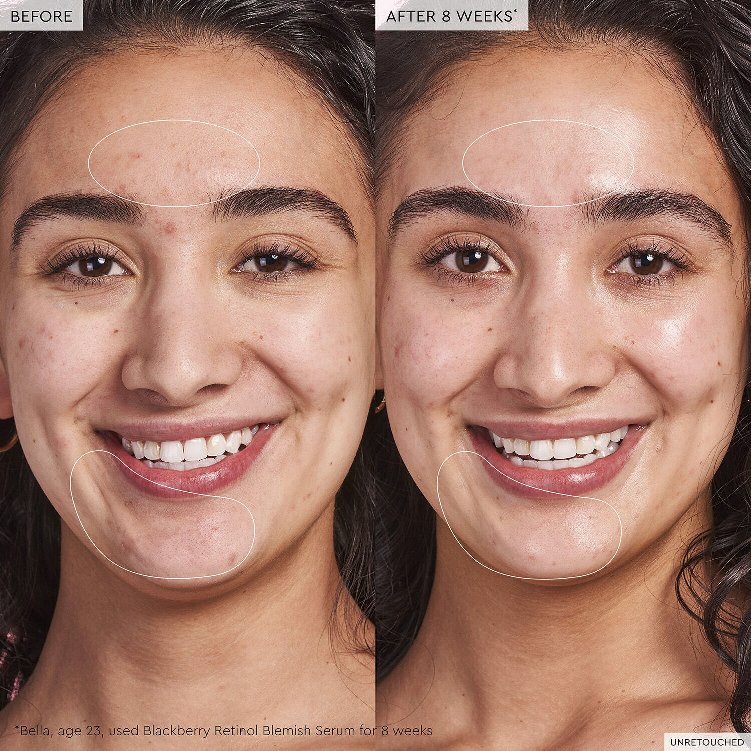 Blackberry Retinol - Serum mot blemmor