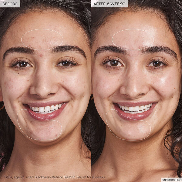 Blackberry Retinol - Serum mot blemmor