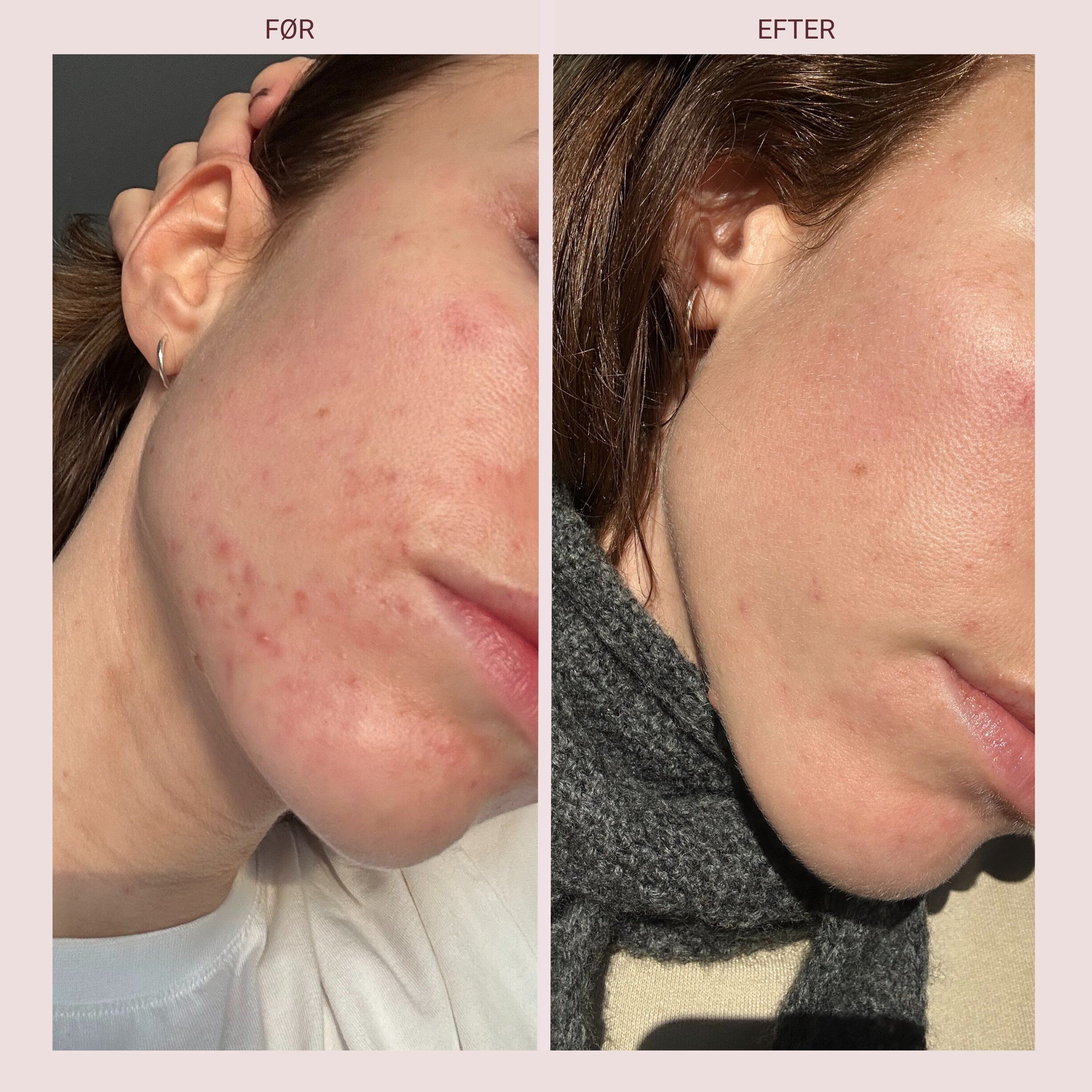 Pudderd&aring;serne Azelainsyre 10%