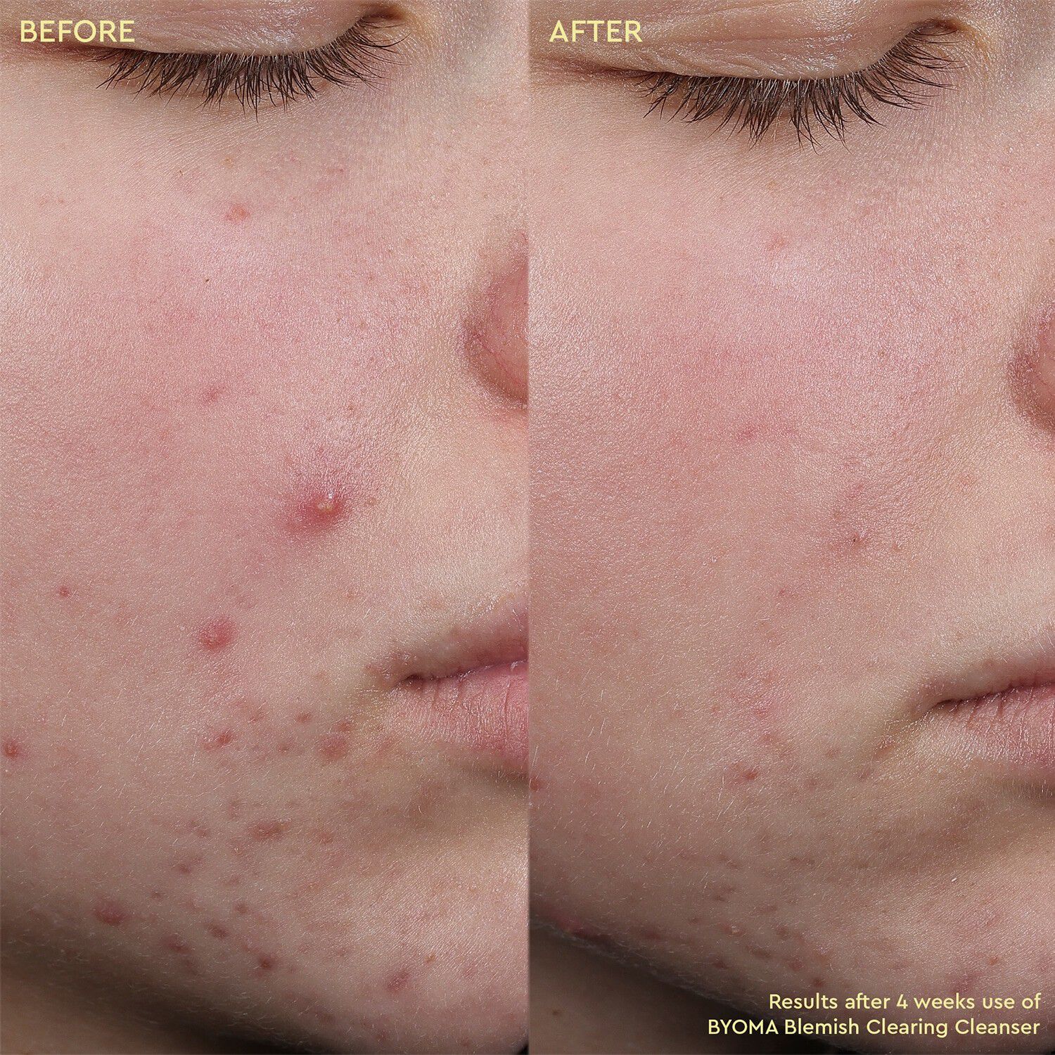 Blemish Clearing Cleanser - Reng&ouml;ring mot oj&auml;mnheter